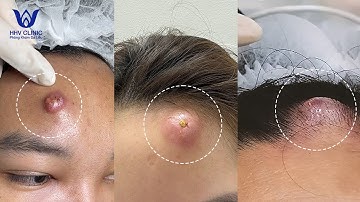 ĐIỀU TRỊ MỤN NHỌT ( VIÊM TỤ CẦU - ÁP XE ) VÙNG TRÁN, HIỆU QUẢ SAU 1 BUỔI, TẠI PHÒNG KHÁM DA LIỄU HHV