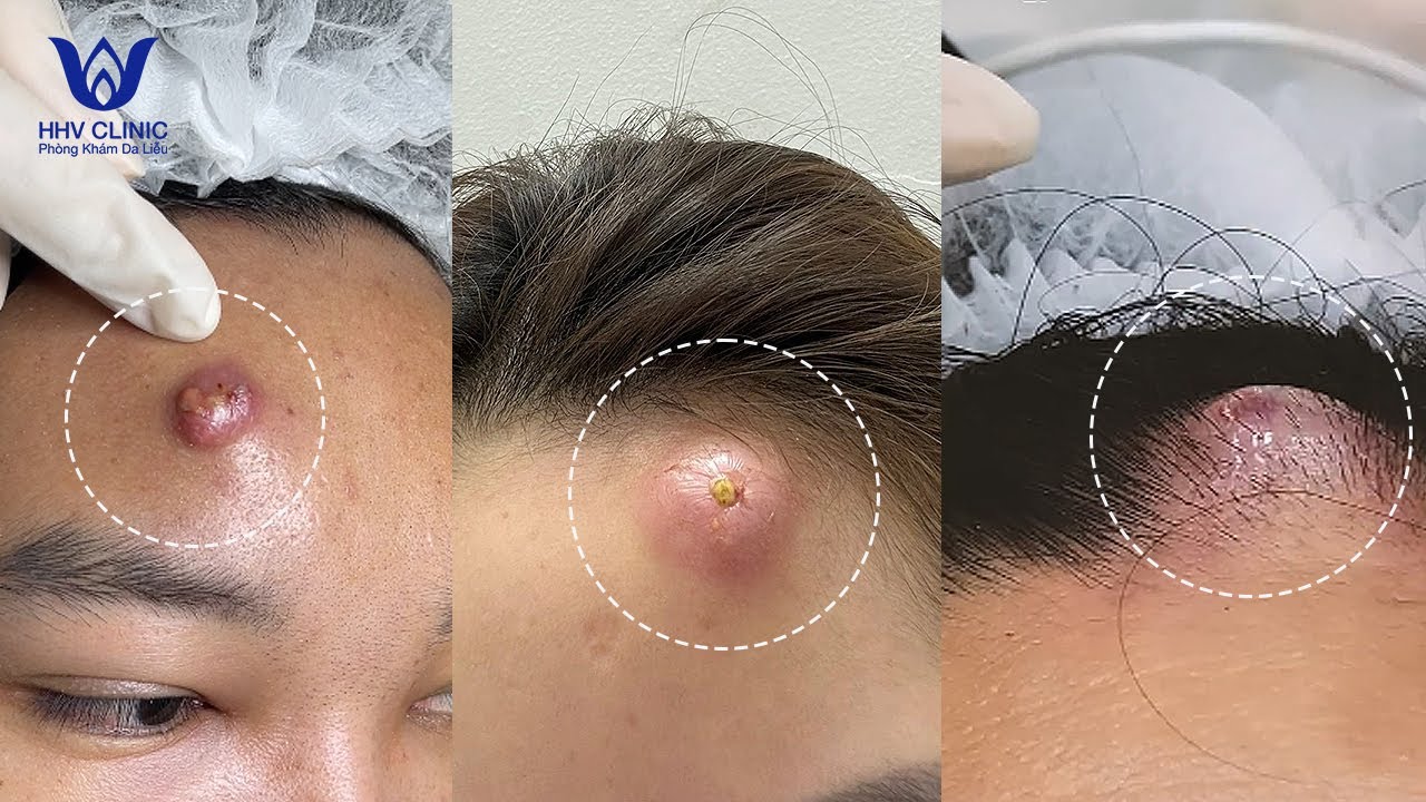 ĐIỀU TRỊ MỤN NHỌT ( VIÊM TỤ CẦU - ÁP XE ) VÙNG TRÁN, HIỆU QUẢ SAU 1 BUỔI, TẠI PHÒNG KHÁM DA LIỄU HHV