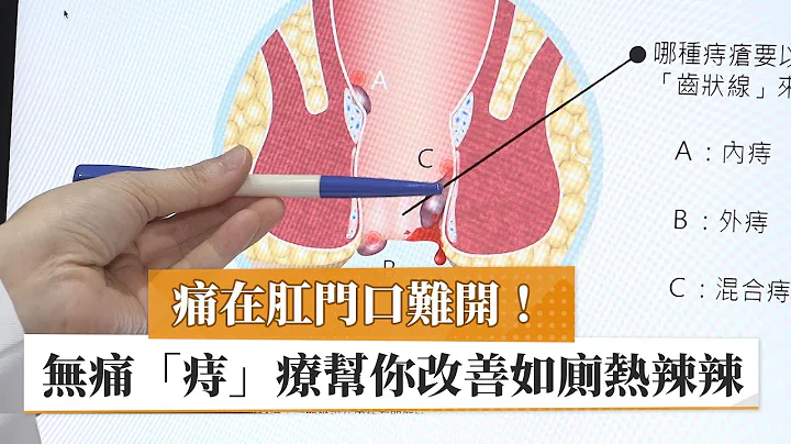 【痔瘡】痛在肛門口難開！　無痛「痔」療幫你改善如廁熱辣辣｜健康醫療網 - 天天要聞