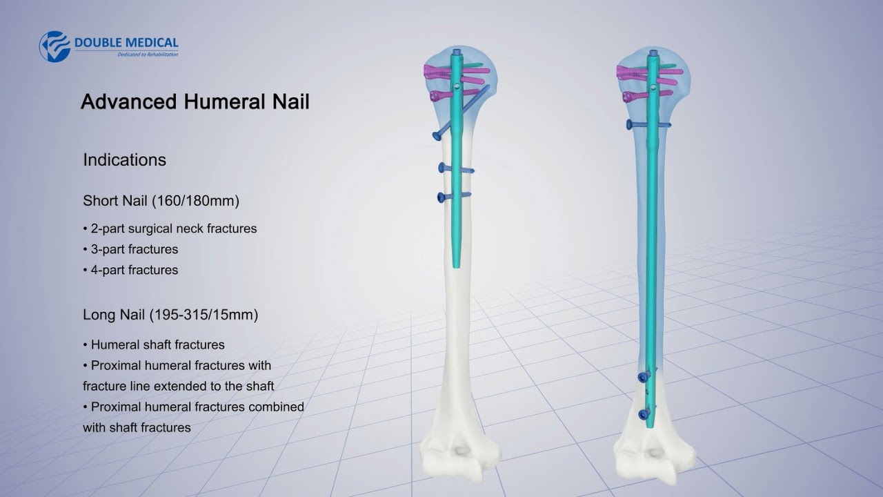 Zimmer Natural Nail System. Tibial Nail Surgical Suprapatella Technique -  PDF Free Download