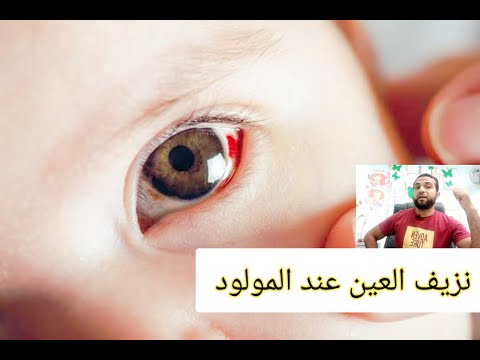 نزيف الملتحمه عند الاطفال حديثي الولاده نقطة دم في عين المولود ياتري ايه السبب