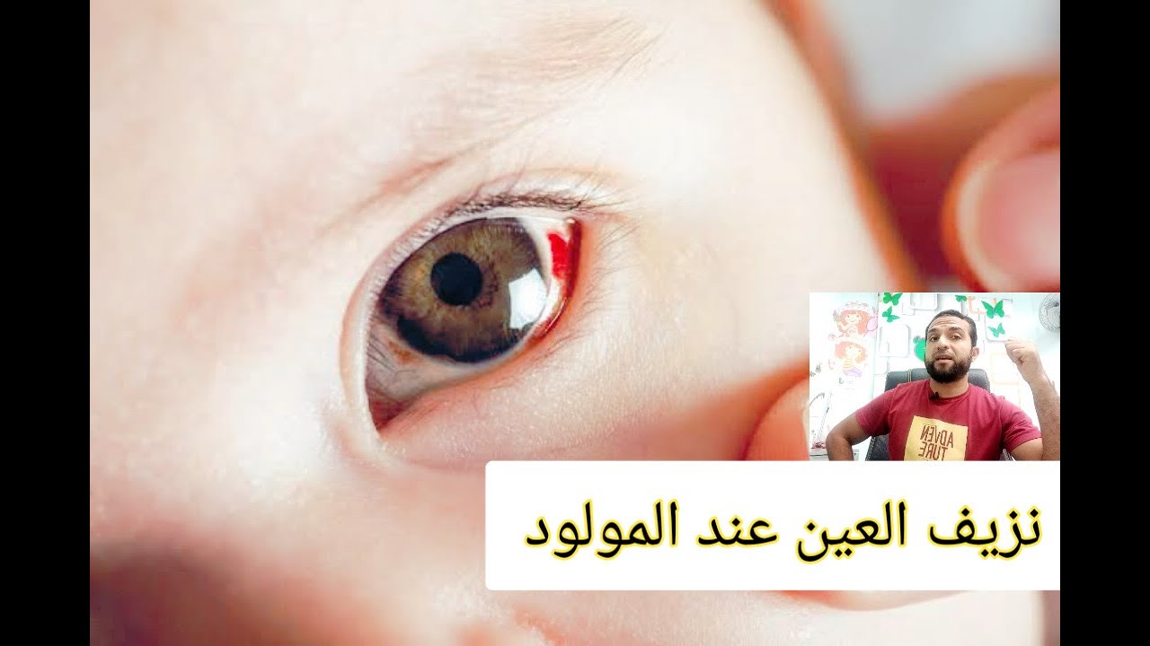 نزيف الملتحمه عند الاطفال حديثي الولاده. نقطة دم في عين المولود ياتري ايه السبب.