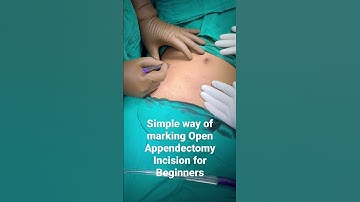 Simple way of marking Open Appendectomy incision for Beginners