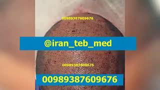 زراعة 6000 بصيلة hair transplant in iran