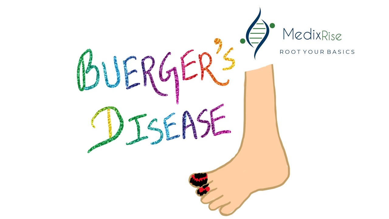 Buerger’s disease Medixrise For Medical students InTheNutShell