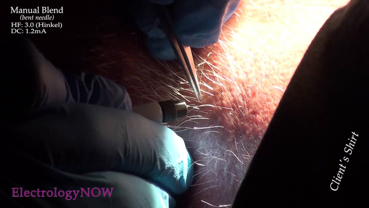 Treating White Hairs With Electrolysis Youtube