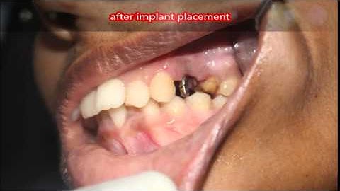 Placement of BCS implant in fresh extraction socket!
