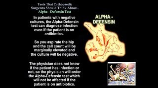 Alpha Defensin,Tests Ortho Surgeons Think About - Everything You Need To Know - Dr. Nabil Ebraheim screenshot 4