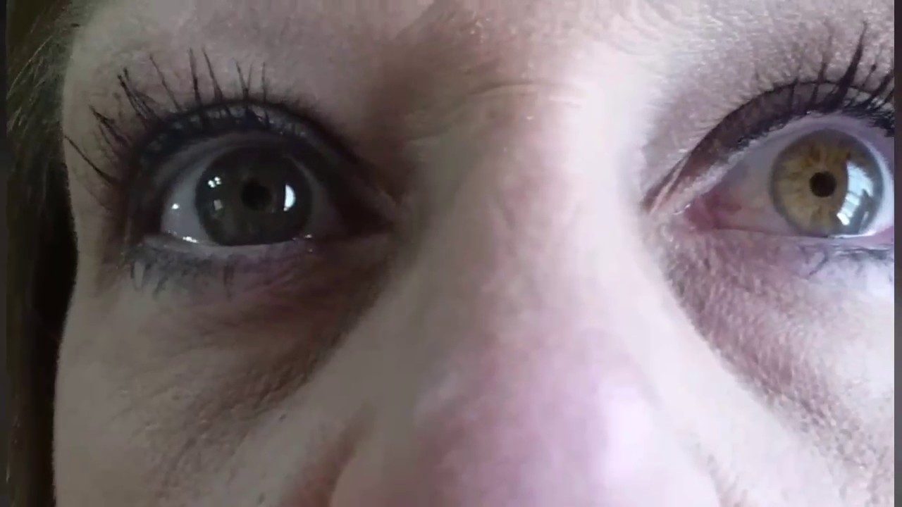 2 weeks postop Tecnis IOLEye twitch, iris wobble 1 YouTube