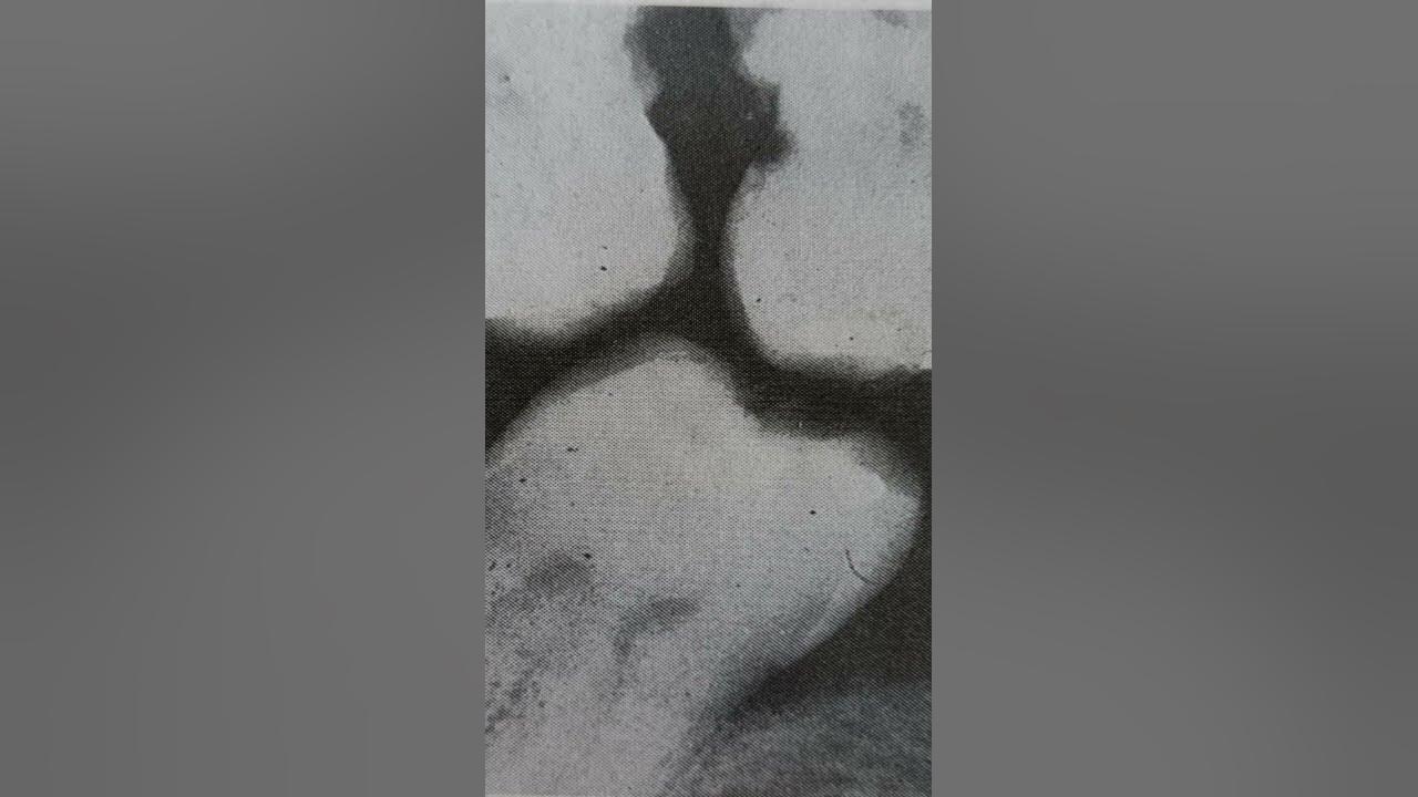 plunger cusp YouTube