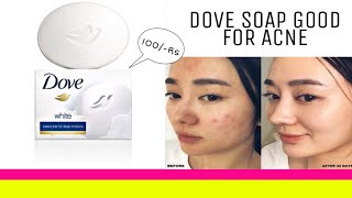 Dove Beauty Bar Soap Review, Uses, Benefits & Price | Dove Soap Best for Acne