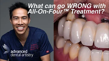 How long do All-on-4 implants last?