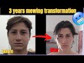 Mewing transformation 35 years 