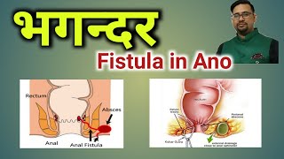 Fistula in Ano| Types of Fistula|Causes of Fistula|भगन्दर,कारण एवं प्रकार| भगन्दर के लक्षण|