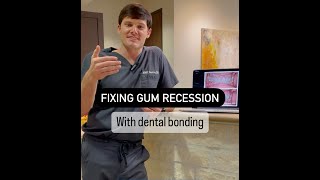 Fixing Gum Recession with Dental Bonding