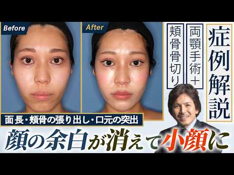 [Contour Surgery] Double Jaw Surgery and Cheekbone Reduction: How Was It? A Real 10-Month Post-Op...