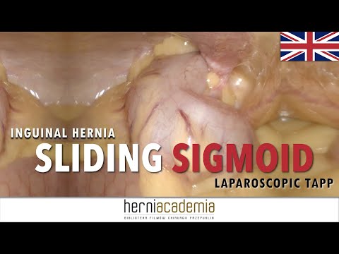 Video: Inguinal Hernia Repair: Oorzaken, Behandelingen En Risico's