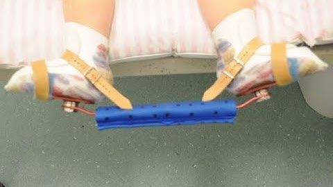 Applying Ponseti Clubfoot Brace (English) - Kerkoc GmbH