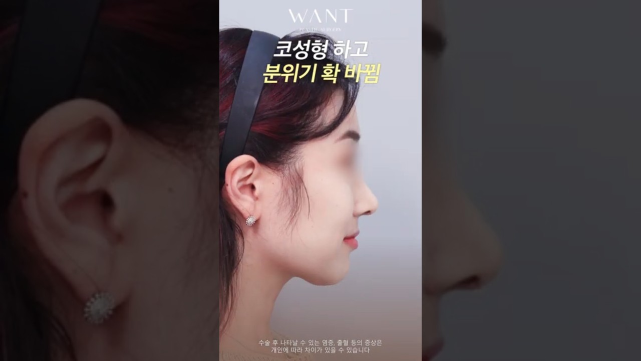 [Вонт гоо сайхны мэс засал] Хамарны силикон имплантгүйгээр төгс болсон шугам😍 Анхны хамар + Хамарны нуруу + Хамарны үзүүр + Өөрийн хавирга + Имплантгүй #шоортс #селфи #хамарны_мэс_засал #шилдэг_газар #рилс