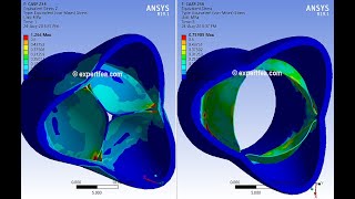 ANSYS WB Static Structural - FEA simulation of the closing and opening of an aortic valve