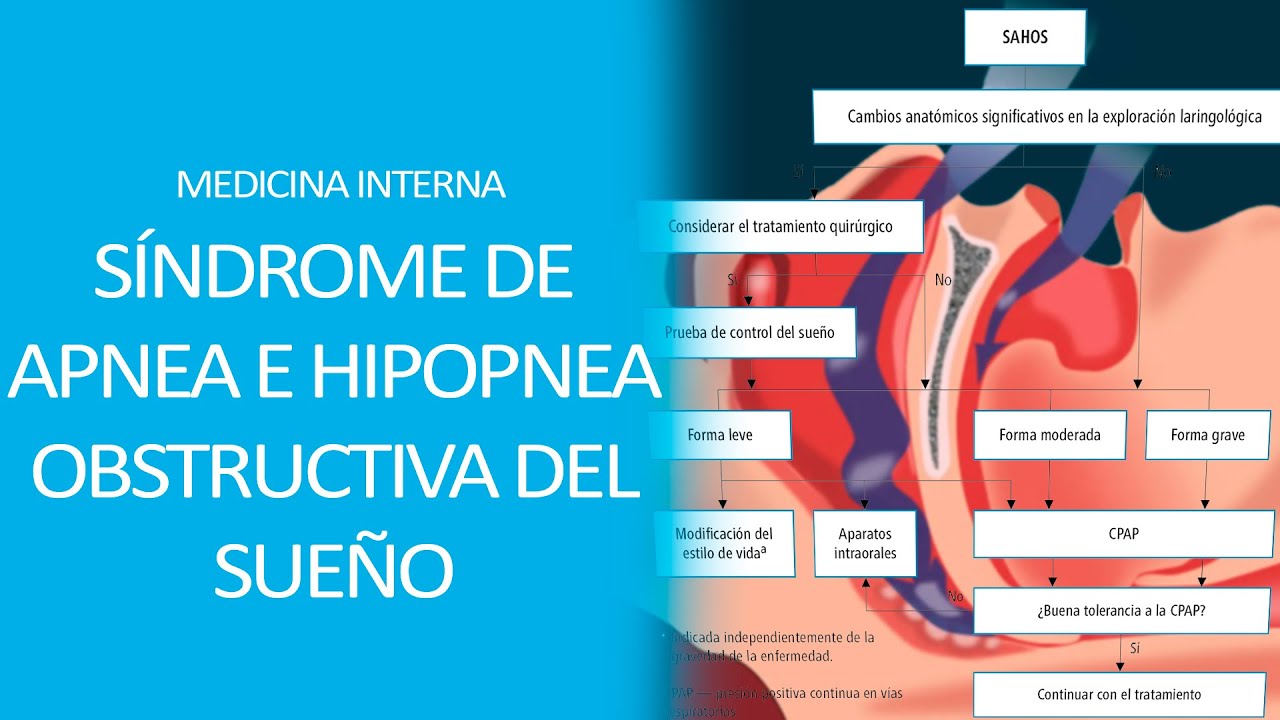 Medicina Interna Síndrome de Apnea e hipopnea Obstructiva del Sueño