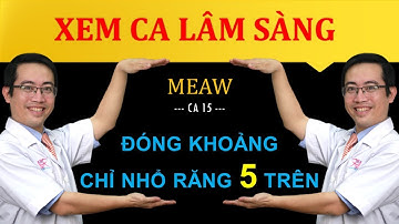 Ca 18 - MEAW - Đóng khoảng trong ca chỉ nhổ răng 5 hàm trên