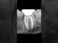 Management of mandibular molar with Periapical lesion and open apex #endodontics #mta #shortvideo