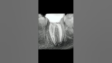 Management of mandibular molar with Periapical lesion and open apex #endodontics #mta #shortvideo