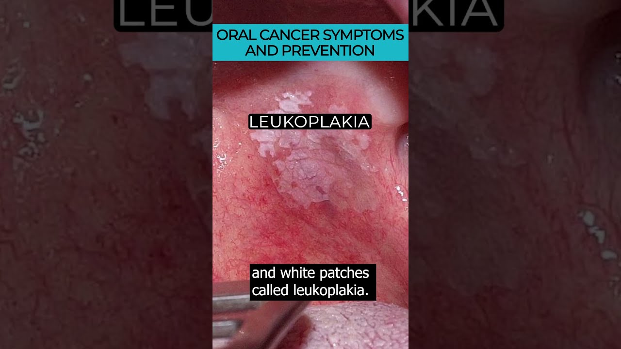 Recognizing Early Signs And Preventing Oral Cancer 