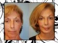 Brian p maloney md facs shares facial plastic surgery before and after facelift photos