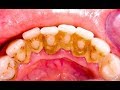 Remoo de trtaro nos dentes em 2 minutos com ultrassom