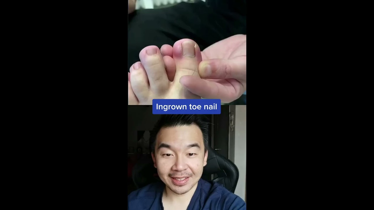 Ingrown Toe Nail Shorts