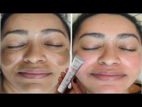 *Depiwhite Cream*For Pigmentation|Hyperpigmentation|Melasma|Acne Scars Complete Honest Review