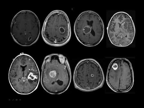 Vídeo: Lesões Cerebrais Da EM: Fotos, Sintomas E Muito Mais