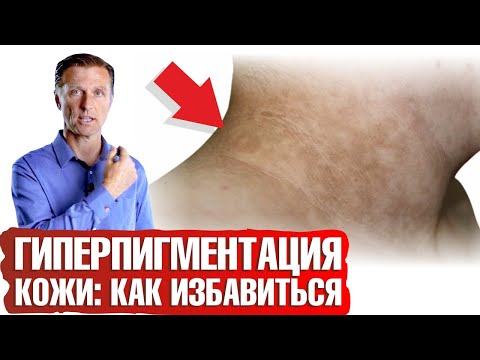 Гиперпигментация кожи👉один простой шаг избавит вас от черного акантоза