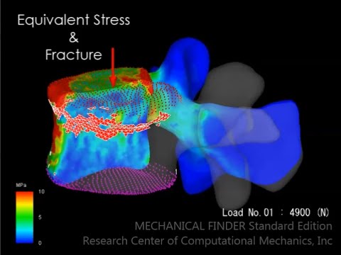 Finite Element Analysis of Vertebral Compression Fracture - YouTube