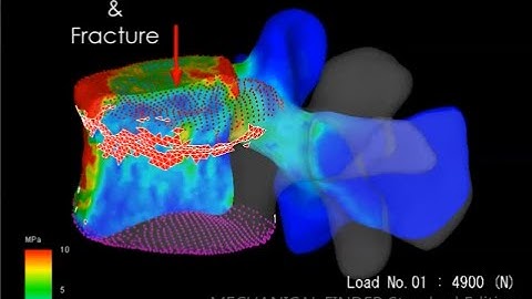 Finite Element Analysis of Vertebral Compression Fracture