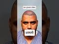 Hair Transplant Result Journey Begins | Ishan Chaudhary Ji | UP Police #hairtutorial #hairgrowth