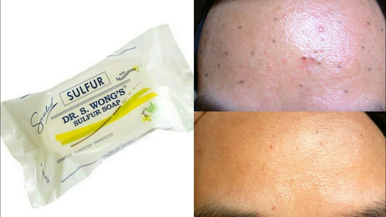 Dr. Wongs's Sulfur Soap with Aloe Vera Extract Review YouTube