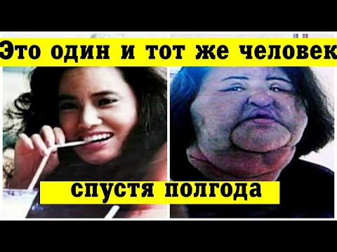 Женщина сама делала себе уколы растительного масла.