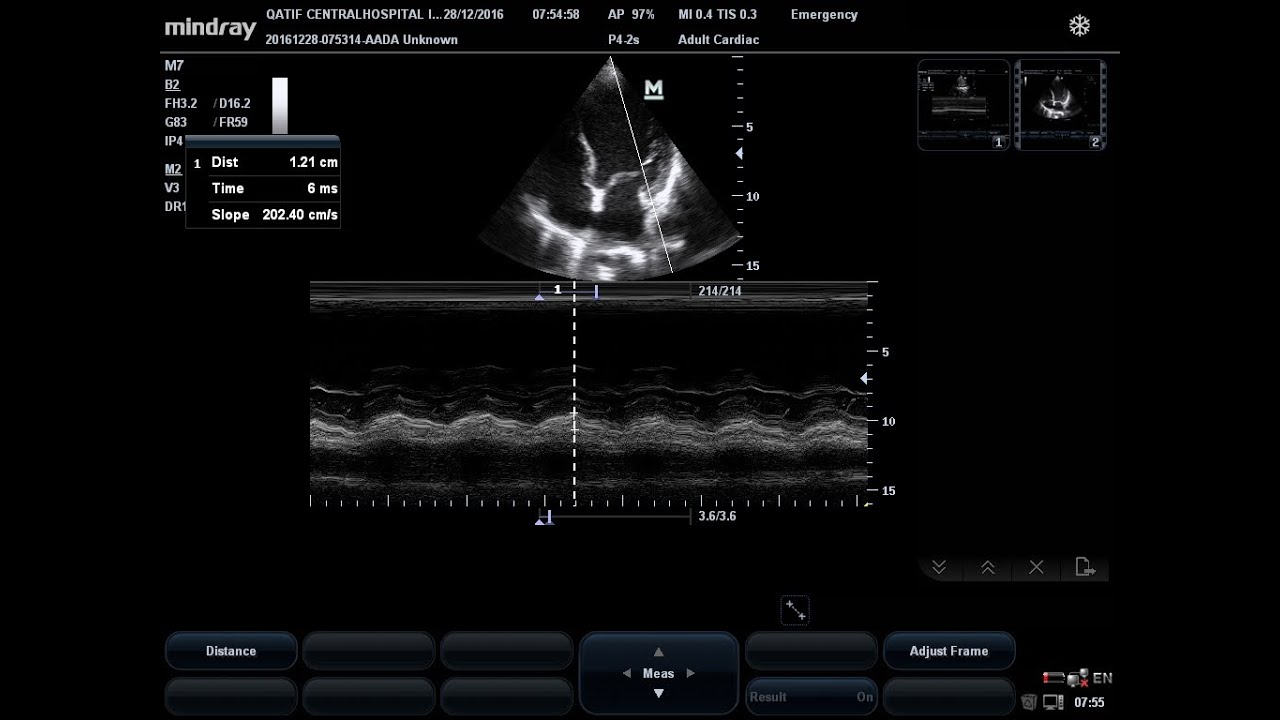 critical care U/S for Seniors[future treatment of shock]