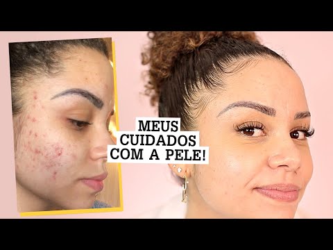 COMO CUIDEI DAS MINHAS ESPINHAS?