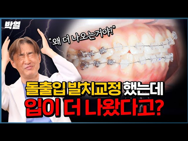 생니까지 뽑고 교정했는데 입이..ㅠ