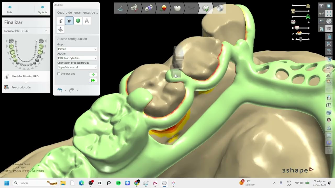 PPR metálico con caras oclusales — planes mensuales PROCA