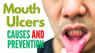 Mouth Ulcers / Canker Sore Causes and Prevention | How to Prevent Ulcers in Mouth