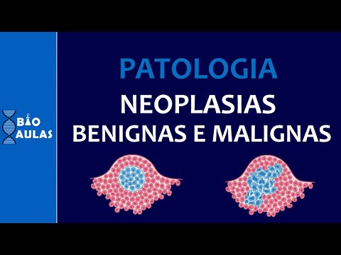 Neoplasias Benignas e Malignas - Características, Nomenclatura e Diferenciação (Patologia Geral)