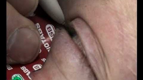 Strabismus botox treatment , medial rectus muscle