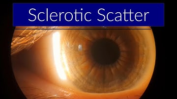 Sclerotic Scatter - Slit Lamp Techniques