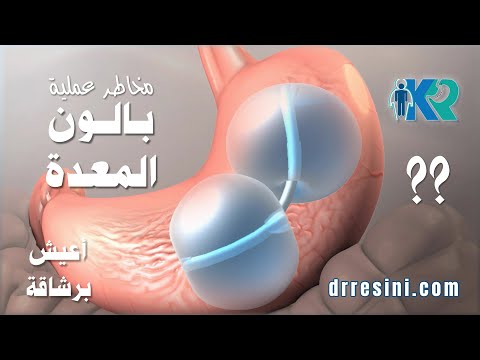 مخاطر عملية بالون المعدة
