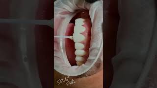 Best Cosmetic Dentist in Chandigarh | Smile Makeover Process With Veneers | Dr Shobit Sethi